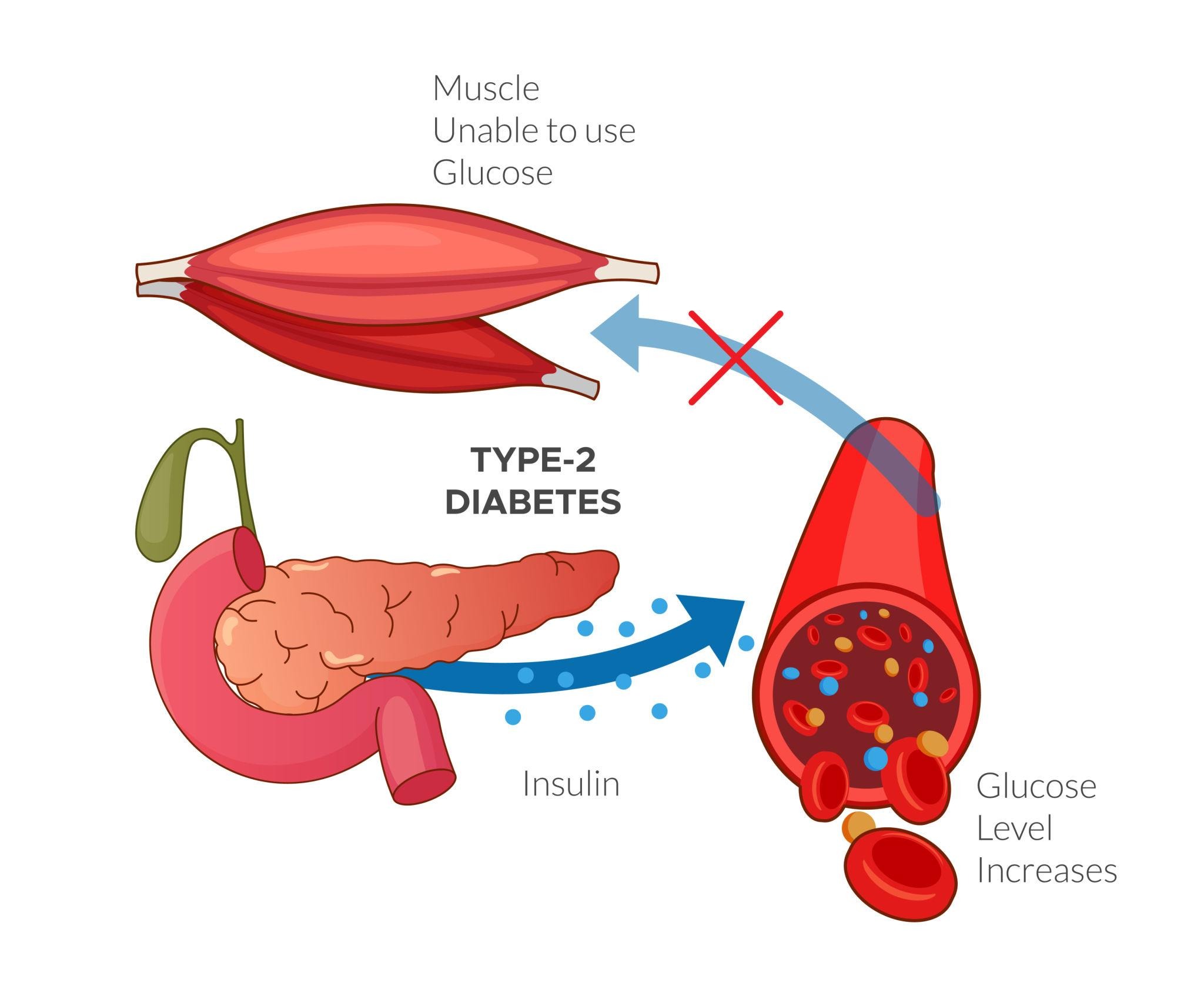 How Long Does It Take to Reverse Type 2 Diabetes?